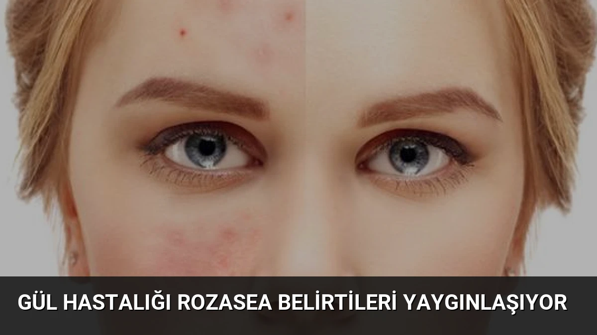 Gül Hastalığı Rozasea Belirtileri Yaygınlaşıyor