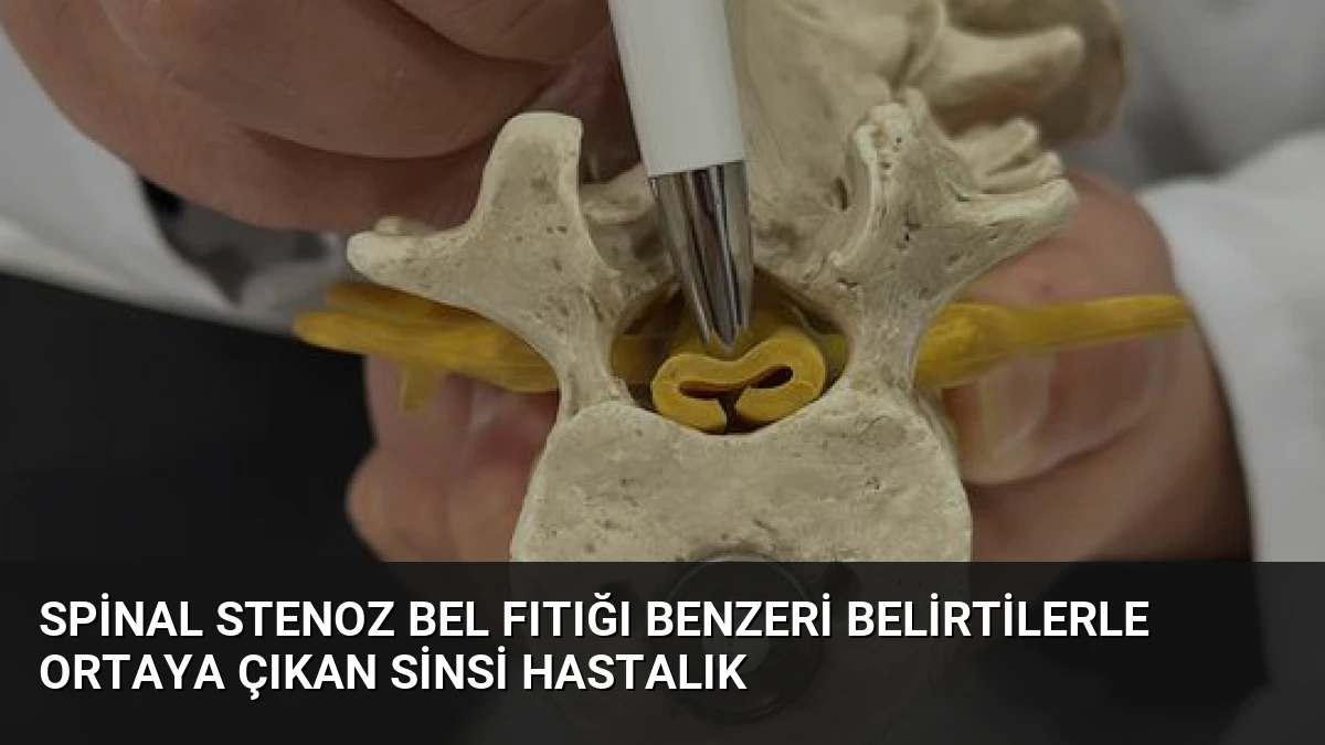 Spinal Stenoz Bel Fıtığı Benzeri Belirtilerle Ortaya Çıkan Sinsi Hastalık