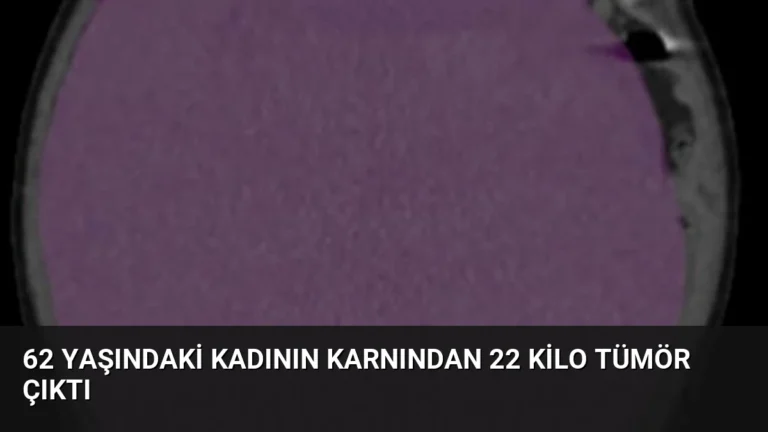 62 Yaşındaki Kadının Karnından 22 Kilo Tümör Çıktı