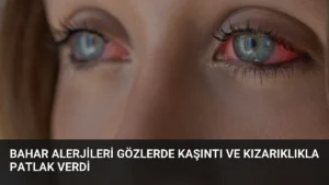Bahar Alerjileri Gözlerde Kaşıntı ve Kızarıklıkla Patlak Verdi