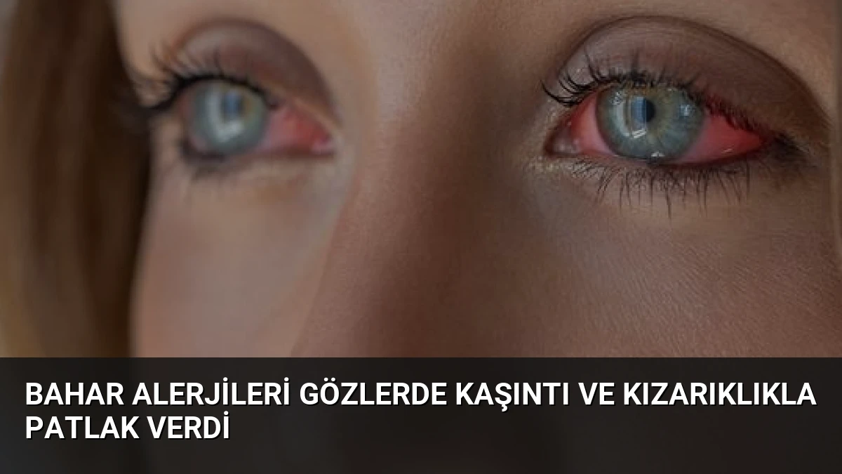 Bahar Alerjileri Gözlerde Kaşıntı ve Kızarıklıkla Patlak Verdi